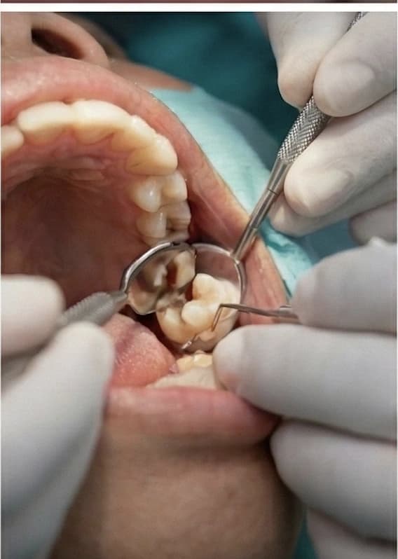 Operasi Gigi Impaksi